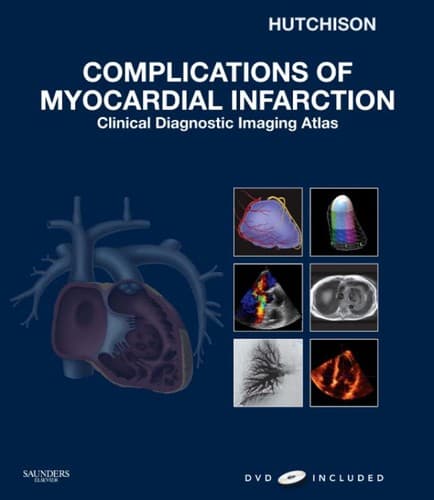 Cover of Complications of myocardial infarction by Stuart J. Hutchison